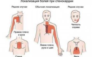 Класифікація стенокардії — симптоми і ознаки патології