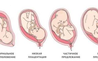Плацента по передній стінці матки — ознаки і можливі варіанти локалізації, ворушіння плода, пологи