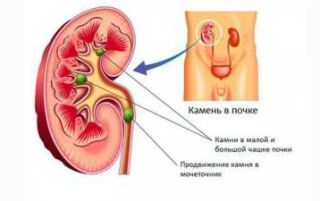 Камені в нирках — причини утворення, видалення, розчинення і дієта