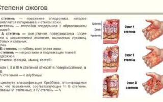 Перша медична допомога при опіках в домашніх умовах — невідкладні заходи