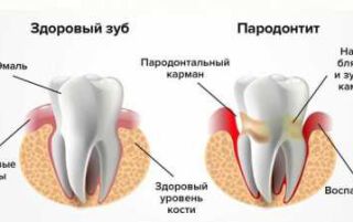 Пародонтит — як лікувати в домашніх умовах препаратами і народними засобами