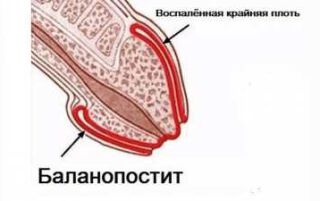 Баланопостит гострий і хронічний — як лікувати в домашніх умовах