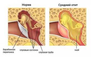 Перша допомога при болю у вусі — використання знеболюючих препаратів