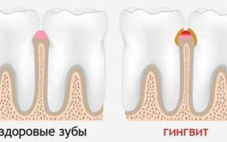 Гінгівіт гострий і хронічний — як лікувати в домашніх умовах