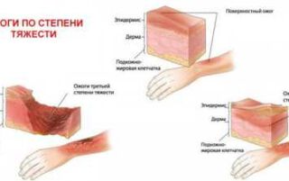 Перша допомога при опіках олією — що дозволено та заборонено робити