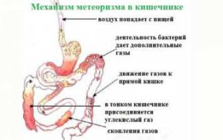 Метеоризм у дорослих — як позбутися ліками і народними засобами