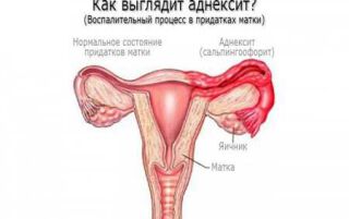 Аднексит: чим лікувати запалення придатків